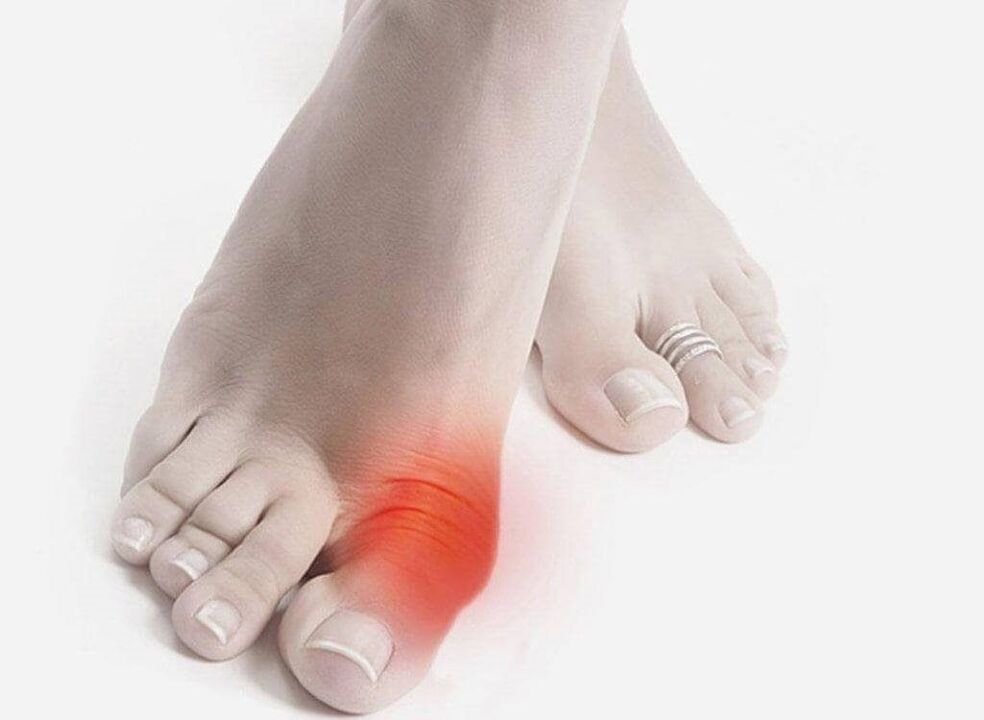 symptoms of gout in the foot